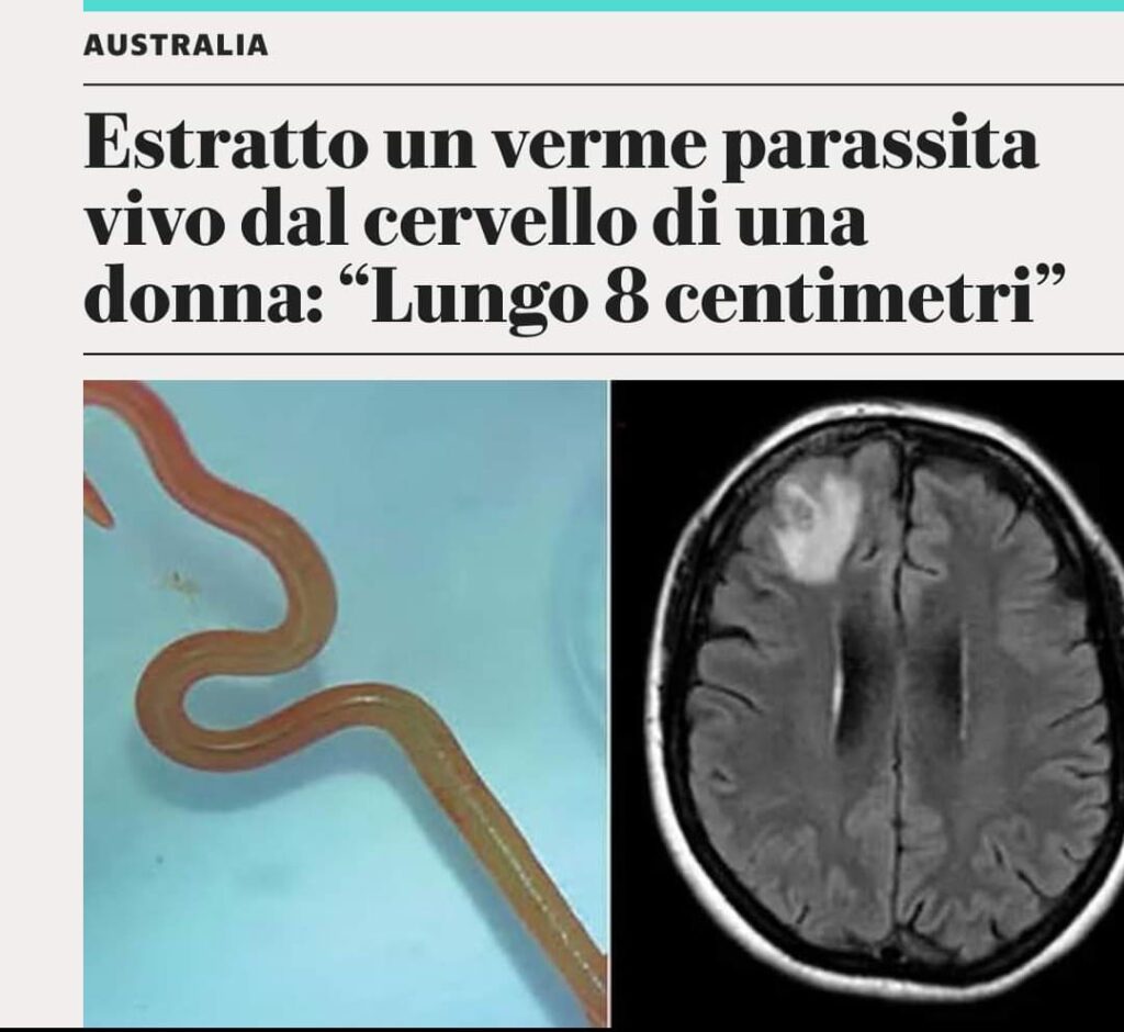 Australia, estratto un verme parassita vivo dal cervello di una donna. “Lungo 8 centimetri, si trova nei pitoni