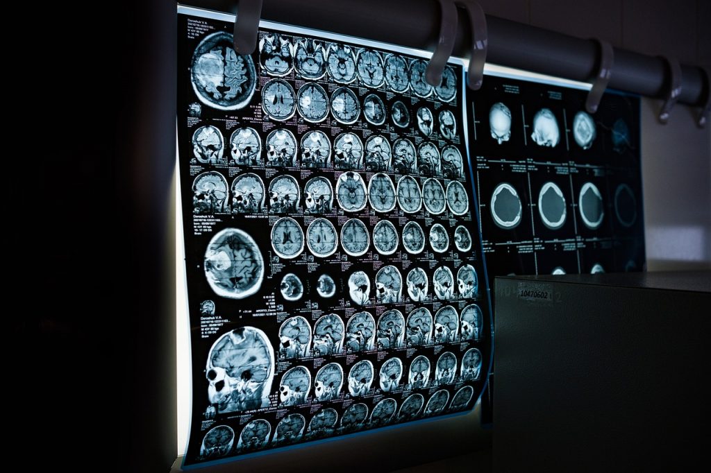 Sottoporsi a una TAC in giovane età aumenta il rischio di cancro