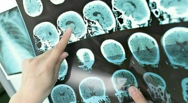 Demenza: scoperti 3 fattori che aumentano il rischio e consigli per la salute mentale