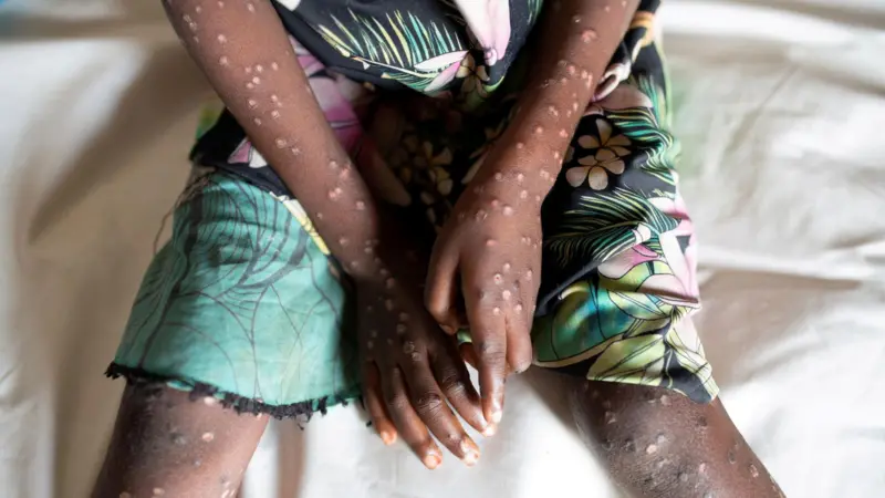 L’OMS dichiara un’emergenza sanitaria internazionale per un focolaio di mpox (vaiolo delle scimmie)