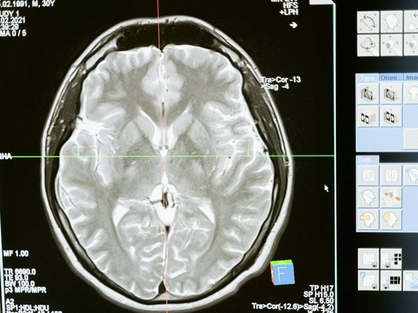 Ecco quali sono i 3 fattori più importanti per prevenire la demenza