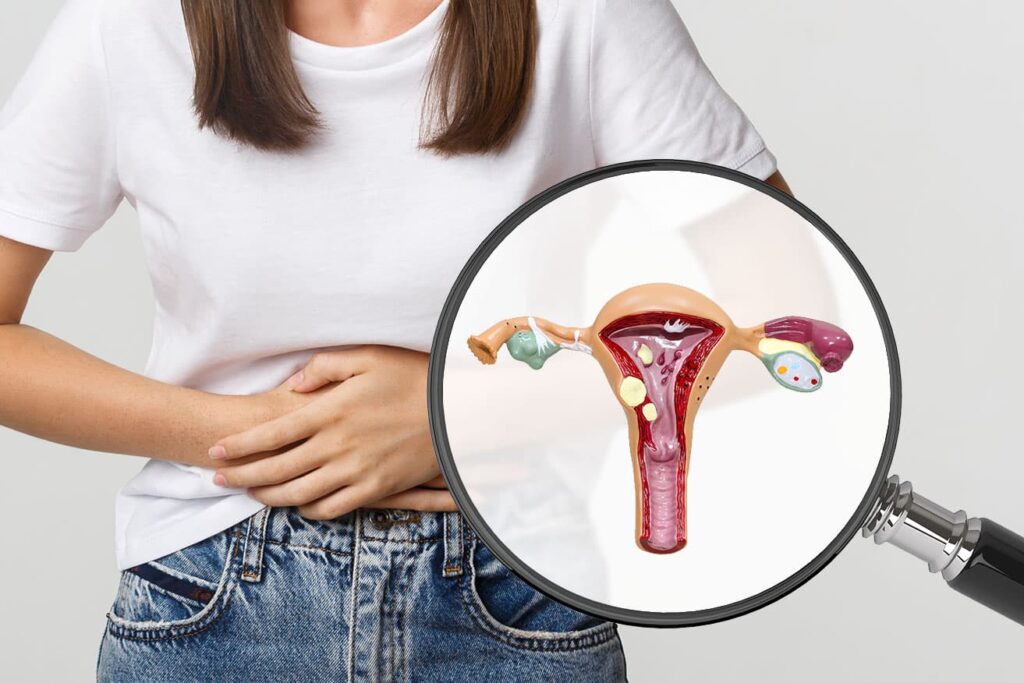 Endometriosi: il 60% delle ragazze che soffre durante il ciclo ne è affetto senza saperlo